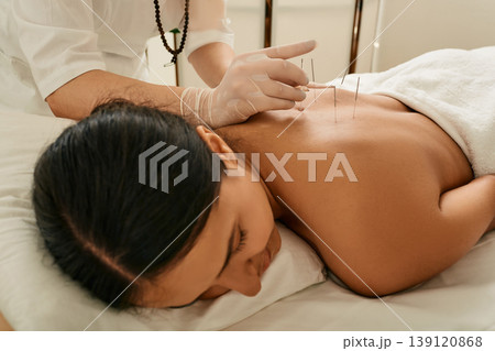 Adult woman relaxing and enjoying during acupuncture procedure. Spine acupressure, puncture of a meridian point on body patient Adult woman relaxing and enjoying during acupuncture procedure. Spine acupressure, puncture of a meridian point on body patient 139120868