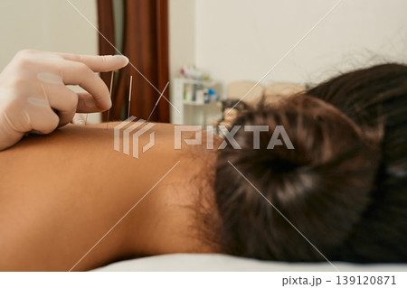 Reflexology. Treatment of back pain and tightness with acupuncture needles for a female patient 139120871