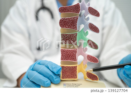 Doctor holding osteoporosis in back bone model for treatment medical. 139127704