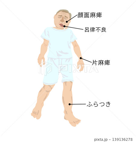 脳卒中の初期症状イラスト|顔面麻痺・呂律不良・片麻痺・ふらつき|高齢者の異変サイン 脳卒中の初期症状イラスト|顔面麻痺・呂律不良・片麻痺・ふらつき|高齢者の異変サイン 139136278