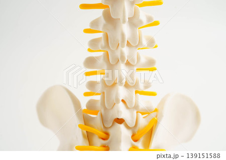 Spinal nerve and bone, Lumbar spine displaced herniated disc fragment, Model for treatment medical in the orthopedic department. Spinal nerve and bone, Lumbar spine displaced herniated disc fragment, Model for treatment medical in the orthopedic department. 139151588