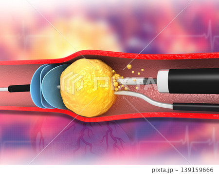 kidney stone removal 139159666