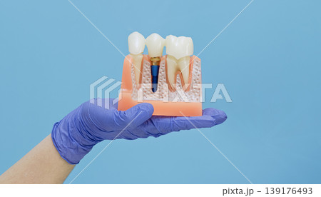 Dentist hand in blue glove holding anatomical cross-section model of teeth and titanium dental implant. Prosthodontics concept with copy space. Dentist hand in blue glove holding anatomical cross-section model of teeth and titanium dental implant. Prosthodontics concept with copy space. 139176493