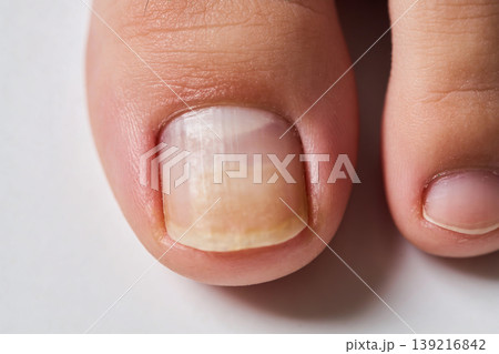 Close-up macro shot of a discolored toenail showing signs of fungal infection and damage Close-up macro shot of a discolored toenail showing signs of fungal infection and damage 139216842