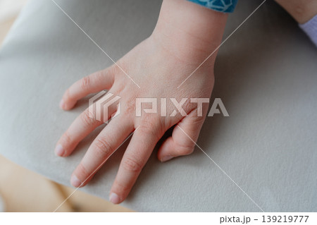 Close-up of child hand with chapped dry skin touching a surface. Skin damage caused by cold weather and lack of moisture. Healthcare and skincare concept. Close-up of child hand with chapped dry skin touching a surface. Skin damage caused by cold weather and lack of moisture. Healthcare and skincare concept. 139219777