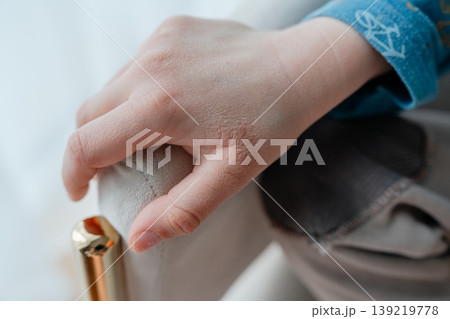 Close-up of a child hand with dry and chapped skin resting on a chair. Concept of skin care, dehydration, cold weather effects, and health issues in children. Close-up of a child hand with dry and chapped skin resting on a chair. Concept of skin care, dehydration, cold weather effects, and health issues in children. 139219778