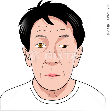動眼神経麻痺(左眼瞼下垂、眼球の外転、瞳孔が大きい)のイラスト 動眼神経麻痺(左眼瞼下垂、眼球の外転、瞳孔が大きい)のイラスト 139231750