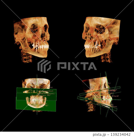 Computed tomography of adult female patient with Temporomandibular joint (TMJ, joint of lower jaw). Dental x-ray of an adult patient showing teeth, jaws and mandibular joint. Modern digital tomography 139234042
