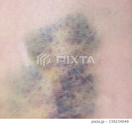 Close up purple bruise on skin. Bruise from impact. Bruising and hematoma on human body Close up purple bruise on skin. Bruise from impact. Bruising and hematoma on human body 139234049