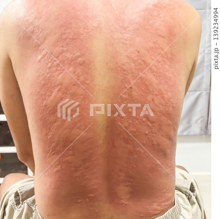 Young asian man itching and scratching on his back from allergic itchy dry skin eczema dermatitis insect bites 139234994