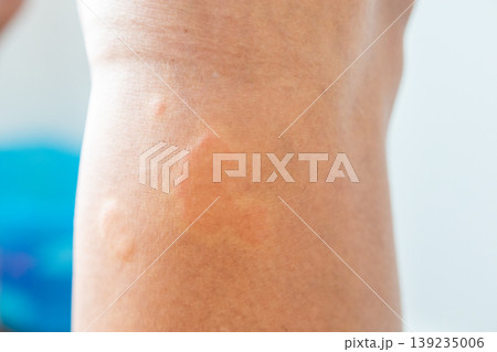 Young asian man has allergic skin rash on his legs from itchy dry skin eczema dermatitis insect bites Young asian man has allergic skin rash on his legs from itchy dry skin eczema dermatitis insect bites 139235006