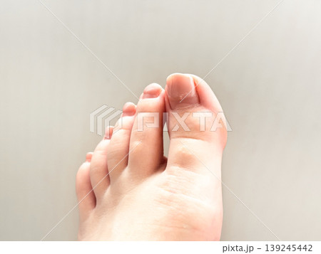 Overgrown natural pedicure, need for update, foot on smooth surface, closeup. Toes arranged in straight line, highlighting, different shapes and sizes. Skin texture and nail details Overgrown natural pedicure, need for update, foot on smooth surface, closeup. Toes arranged in straight line, highlighting, different shapes and sizes. Skin texture and nail details 139245442