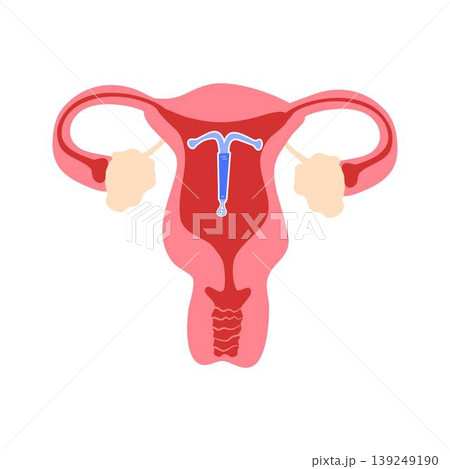 Illustration of Intrauterine Device in Uterus 139249190