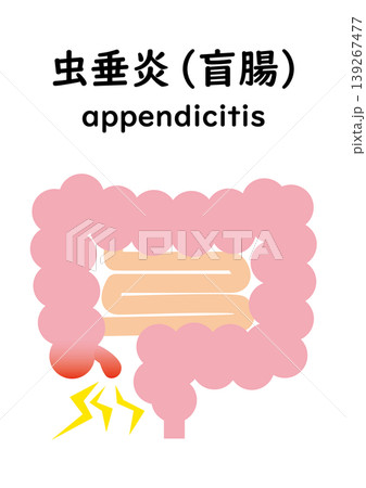 虫垂炎になった大腸 139267477