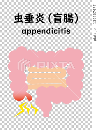 虫垂炎になった大腸 139267477