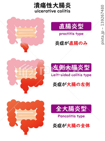 潰瘍性大腸炎 潰瘍性大腸炎 139267480