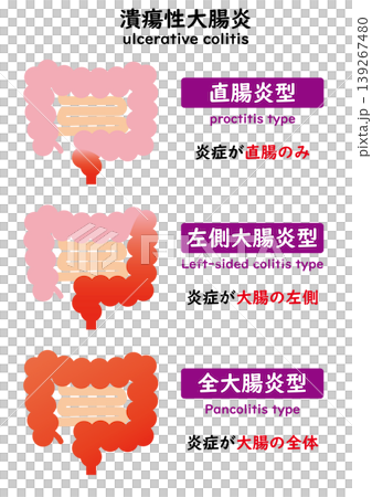 潰瘍性大腸炎 潰瘍性大腸炎 139267480