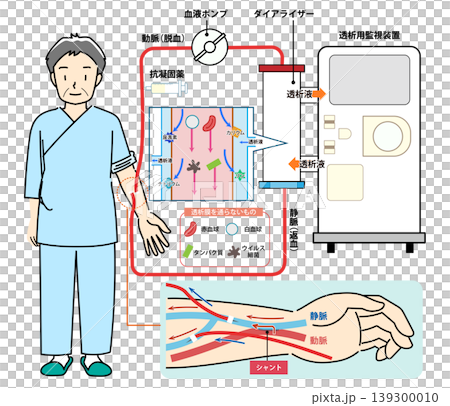 An illustration that clearly shows how hemodialysis works. An illustration that clearly shows how hemodialysis works. 139300010