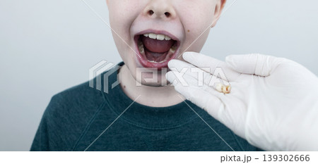 10 year old boy at pediatric dentist showing milk tooth extraction. Concept of caries treatment, physiological change of teeth and permanent teeth eruption in school age children. 10 year old boy at pediatric dentist showing milk tooth extraction. Concept of caries treatment, physiological change of teeth and permanent teeth eruption in school age children. 139302666