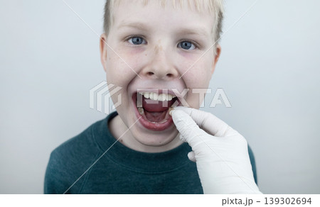 10 year old boy at pediatric dentist showing milk tooth extraction. Concept of caries treatment, physiological change of teeth and permanent teeth eruption in school age children. 10 year old boy at pediatric dentist showing milk tooth extraction. Concept of caries treatment, physiological change of teeth and permanent teeth eruption in school age children. 139302694