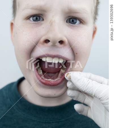 10 year old boy at pediatric dentist showing milk tooth extraction. Concept of caries treatment, physiological change of teeth and permanent teeth eruption in school age children. 139302696