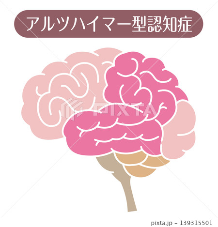 アルツハイマー型認知症 脳イラスト 線なし 139315501