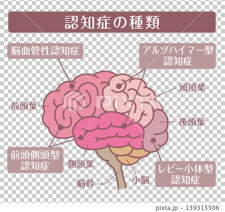 癡呆症的類型:大腦輪廓圖。 癡呆症的類型:大腦輪廓圖。 139315506