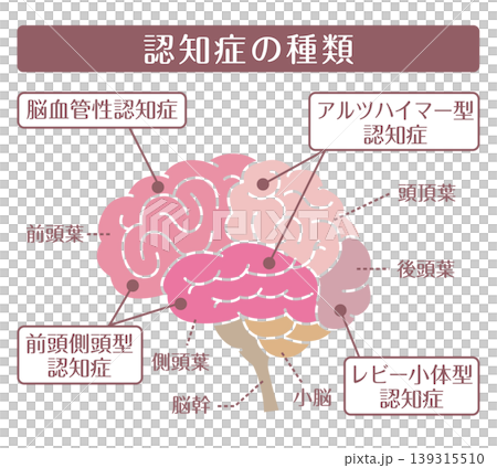 失智症的類型：大腦示意圖（無線條） 139315510