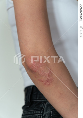 Vertical close-up of woman showing psoriasis on elbow, skin disease and dermatology concept 139326927