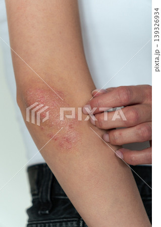 Vertical close-up of woman scratching elbow with psoriasis, skin itching and dermatology concept Vertical close-up of woman scratching elbow with psoriasis, skin itching and dermatology concept 139326934