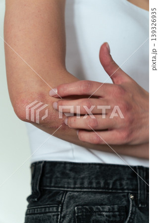 Vertical close-up of woman scratching elbow with psoriasis, skin itching and dermatology concept Vertical close-up of woman scratching elbow with psoriasis, skin itching and dermatology concept 139326935