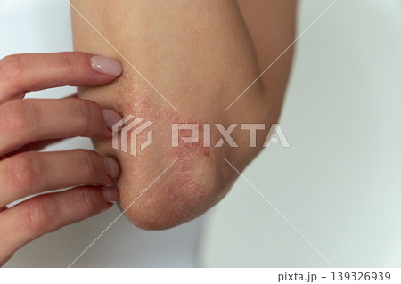 Woman scratching psoriasis on elbow, skin itching and dermatology medical concept Woman scratching psoriasis on elbow, skin itching and dermatology medical concept 139326939