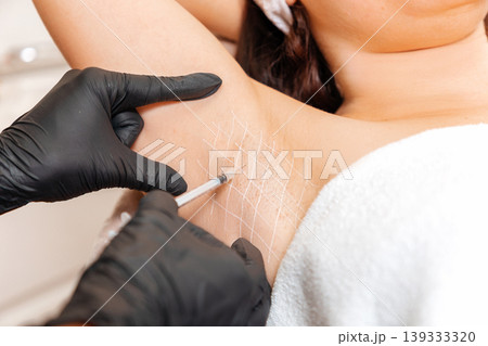 Cosmetologist in black latex gloves makes injection of botulinum toxin on the woman's axillary hollows against hyperhidrosis. Armpit with white drawn grid. Close up 139333320