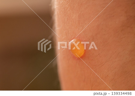 Macro of a small round blister on a skin after burn. Male leg, many tiny hairs, scald close up Macro of a small round blister on a skin after burn. Male leg, many tiny hairs, scald close up 139334498