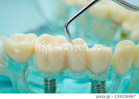 Teeth dental model with tool for dentist use to cleaning care treatment. 139336967