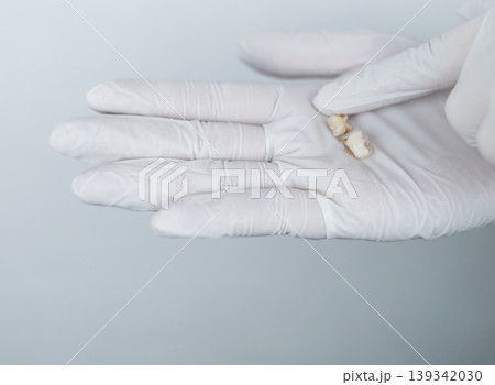 Pediatric dentist in white gloves holding extracted primary milk teeth. Concept of deciduous tooth loss, dental extraction procedure and childhood healthcare. 139342030