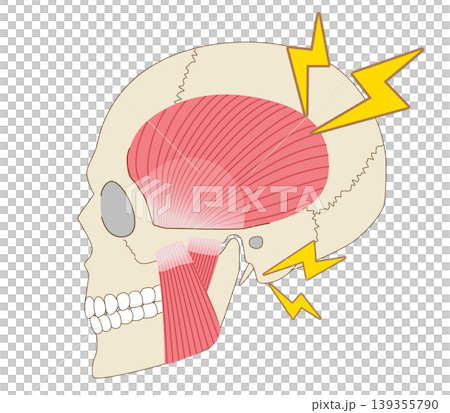 An illustration illustrating the relationship between jaw joint pain and discomfort, teeth grinding, and muscles. 139355790