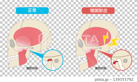 顎関節症と正常な頭蓋骨と筋肉を横から見た比較イラスト 顎関節症と正常な頭蓋骨と筋肉を横から見た比較イラスト 139355792