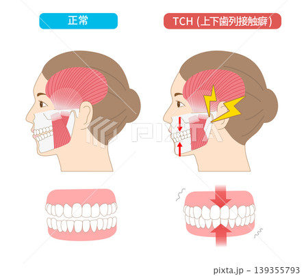 上下の歯を無意識に接触させてしまうTCH(歯列接触癖)と正常な歯との比較イラス 上下の歯を無意識に接触させてしまうTCH(歯列接触癖)と正常な歯との比較イラス 139355793