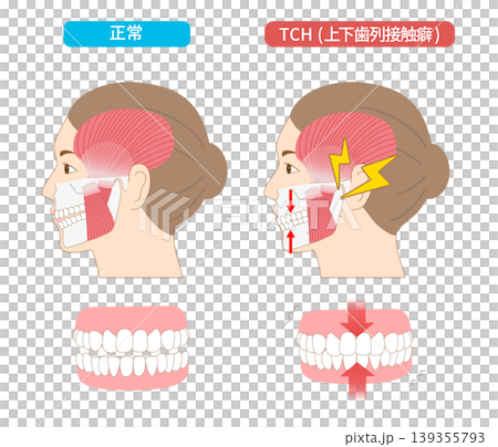 上下の歯を無意識に接触させてしまうTCH(歯列接触癖)と正常な歯との比較イラス 上下の歯を無意識に接触させてしまうTCH(歯列接触癖)と正常な歯との比較イラス 139355793