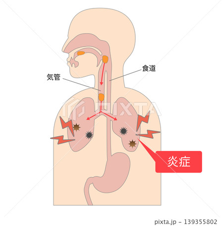誤嚥性肺炎により食べ物が気管に入り肺で炎症を引き起こす際のメカニズム 139355802