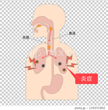 誤嚥性肺炎により食べ物が気管に入り肺で炎症を引き起こす際のメカニズム 139355802