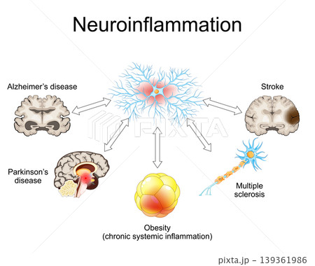 Neuroinflammation. Link between chronic systemic inflammation, stroke, neurodegenerative diseases, Multiple sclerosis, Alzheimers disease, Parkinsons disease, and obesity. ageing process. Neuroinflammation. Link between chronic systemic inflammation, stroke, neurodegenerative diseases, Multiple sclerosis, Alzheimers disease, Parkinsons disease, and obesity. ageing process. 139361986