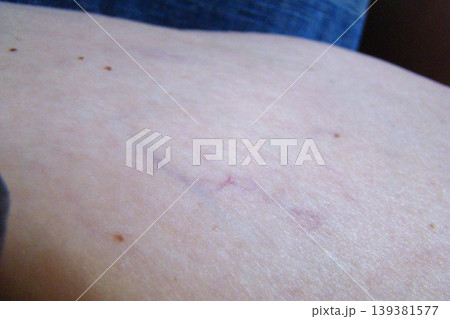 varicose veins 139381577