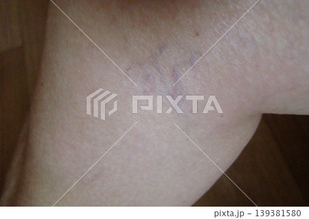 varicose veins 139381580