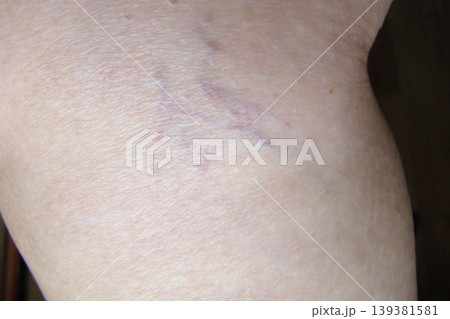 varicose veins 139381581