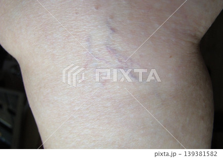 varicose veins varicose veins 139381582