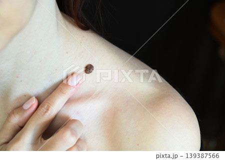 A woman examines a large mole on her neck. 139387566