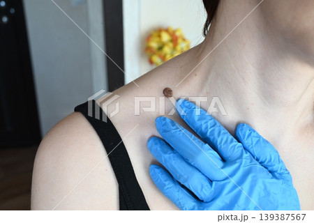 control of moles by a doctor wearing blue gloves on a female patient palpating the mole control of moles by a doctor wearing blue gloves on a female patient palpating the mole 139387567