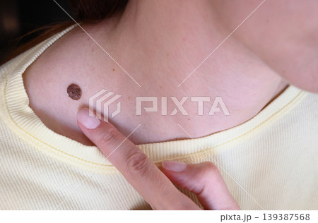 A woman examines a large mole on her neck. 139387568